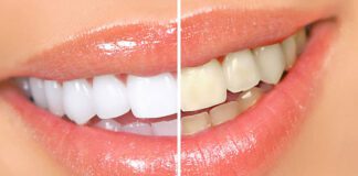 ¿Cuánto dura el blanqueamiento dental?